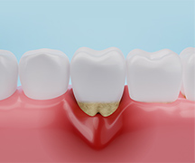 歯周病について