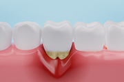 歯周病について