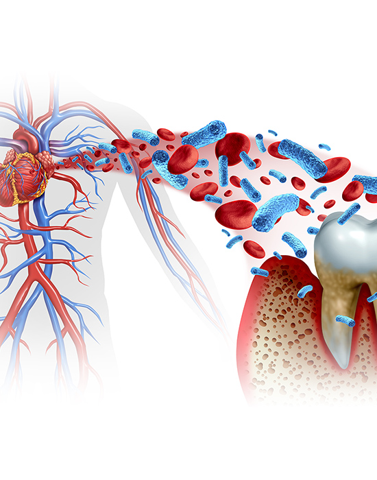 EFFECTS OF PERIODONTAL DISEASE 歯周病は、お口の中だけの 問題ではありません