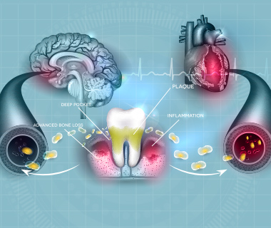 歯周病と全身の関係
