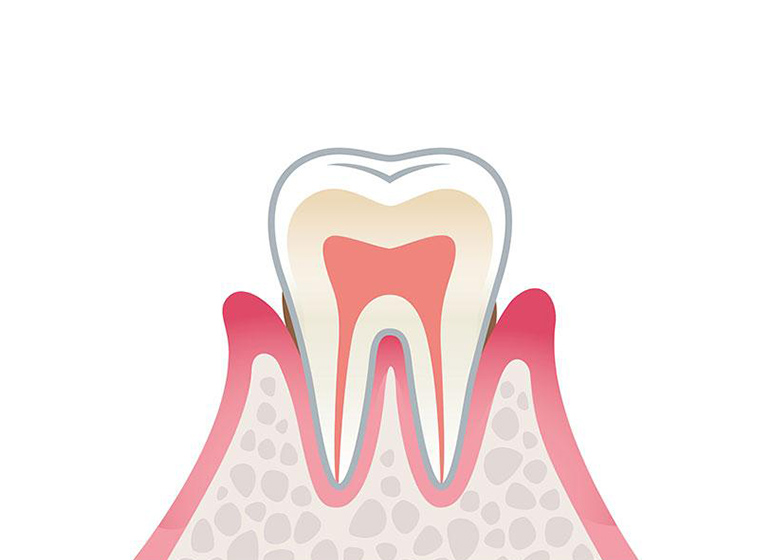 軽度歯周炎