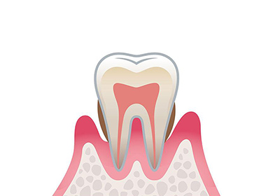 中度歯周炎
