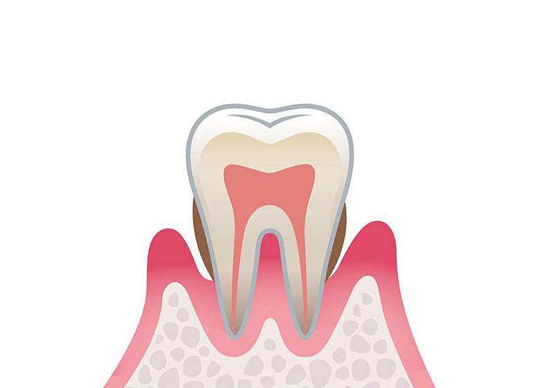 中度歯周炎