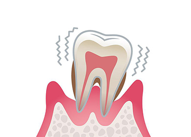 重度歯周炎