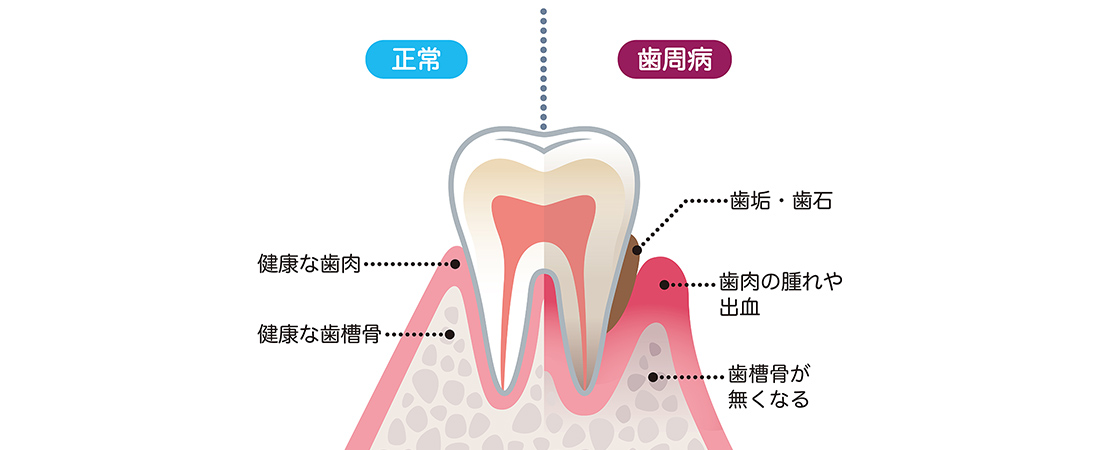 歯周病とは