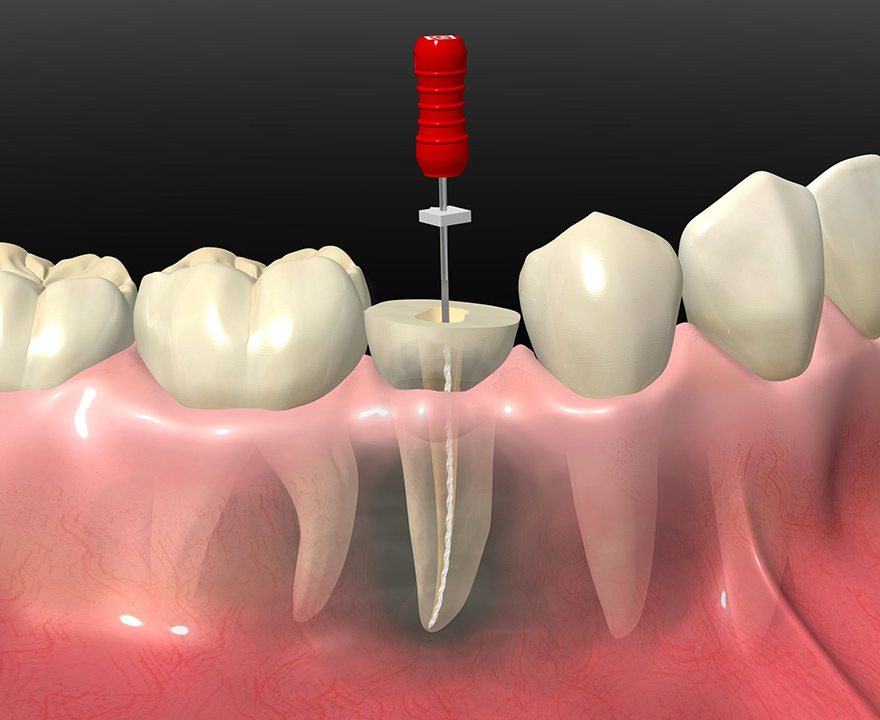 根管治療