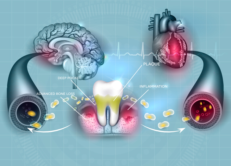 歯周病と全身との関係