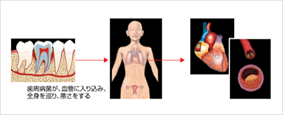 歯周病と心臓血管疾患