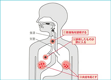 歯周病と肺炎