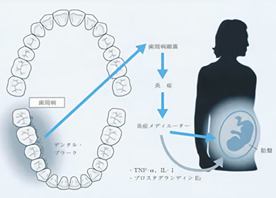 歯周病と低体重児