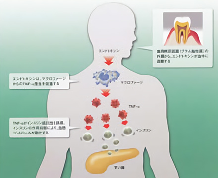 歯周病と糖尿病